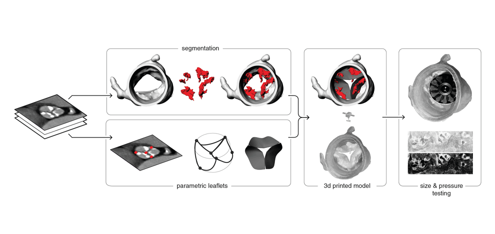 pre-procedural-fit-testing-transcatheter-aortic-valve-replacement-tavr-valves-using-parametric-modeling-3d-printing-1